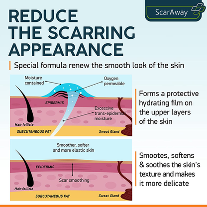 ❤️Advacnced Scar Spray For All Types of Scars- For Example Acne Scars, Surgical Scars and Stretch Marks⚡⚡⚡